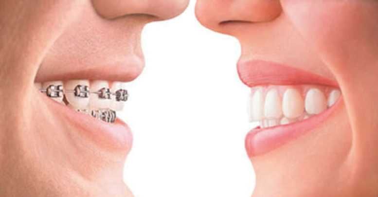 ortodontik-dis-teli-tedavisi.jpg